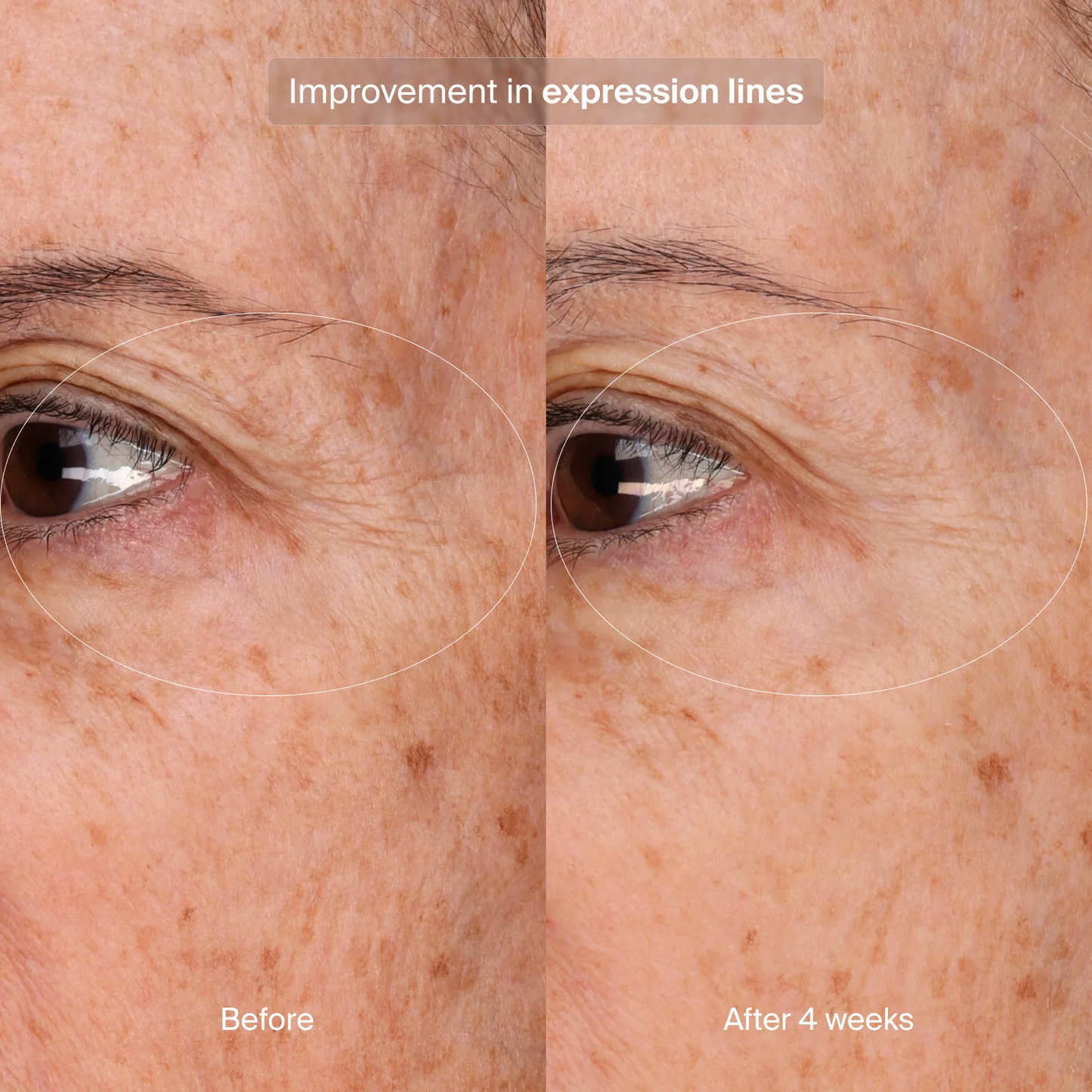 Precision Eye Lift