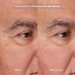 Precision Eye Lift