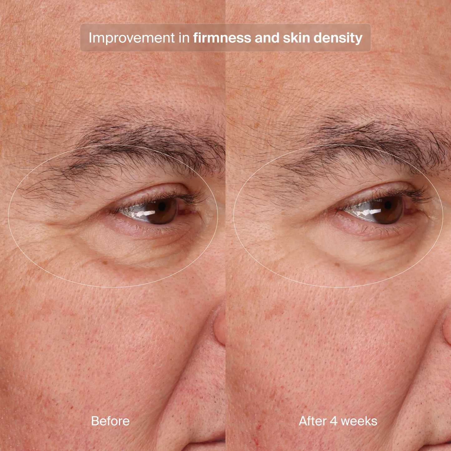 Precision Eye Lift